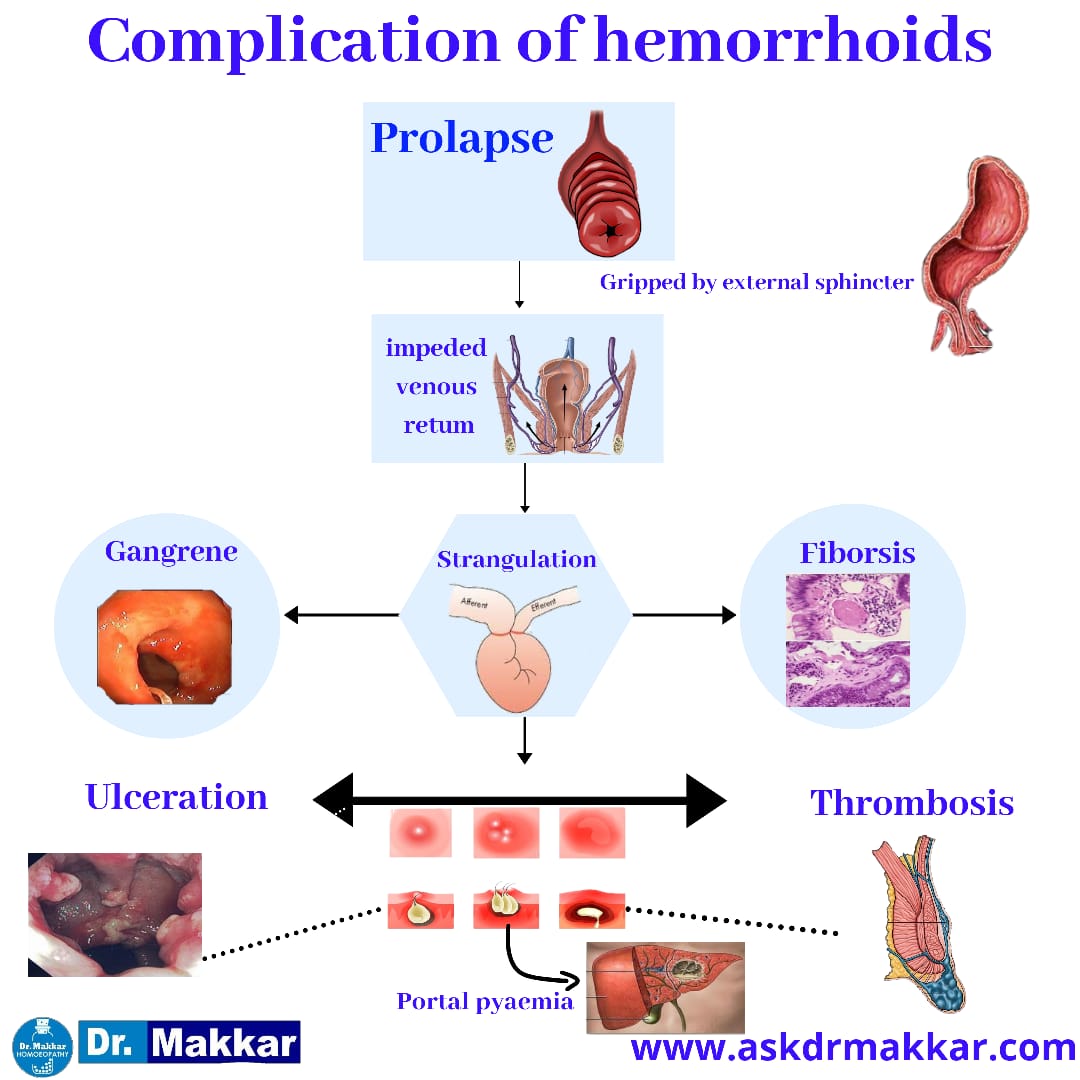 Complications of hemorrhoids are rare but include followings || बवासीर की जटिलताओं दुर्लभ हैं, लेकिन निम्नलिखित शामिल हैं by homeopthic Dr Makkar